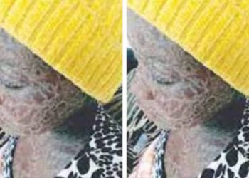 Girl contracts rare skin disease from ‘invisible snake that licks her up’