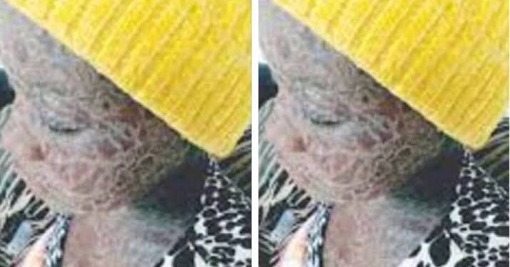 Girl contracts rare skin disease from ‘invisible snake that licks her up’