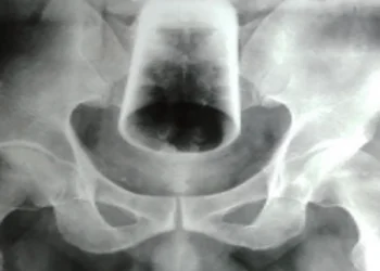 Man, 47, undergoes surgery after inserting water glass in his rectum, leaving it there for 3 days