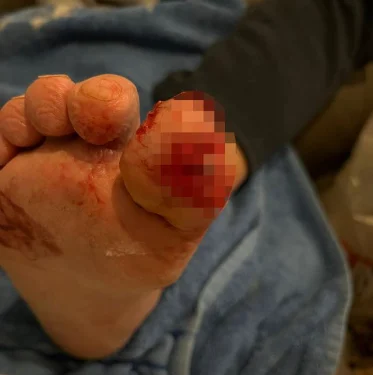 Man wakes to find his puppy has chewed his big toe to the bone but it saved his life
