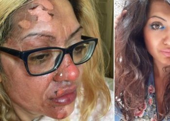 Mum left with skin peeling off her face after egg exploded during TikTok challenge