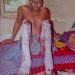 Gas Explosion injures 27 year old Ebonyi man,  seeks financial assistance