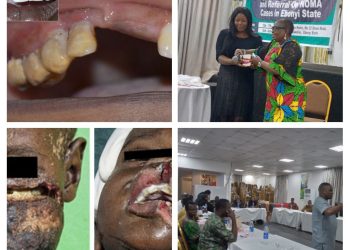 NGO Trains Ebonyi Health Workers On Eradication Of Noma Disease, Flag off Free Medical treatment for Noma Patients