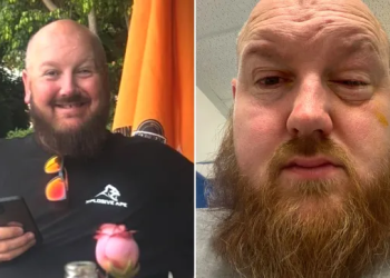 Man used woman’s placenta to re-build his eye and save his sight after acid attack