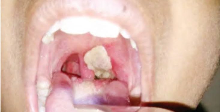 Diphtheria Outbreak Claims 10 Children In Niger