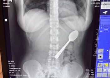 17cm spoon ‘moving inside’ woman after freak accident